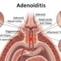 Understanding adenoidid: Causes, Symptoms, and Treatment Options